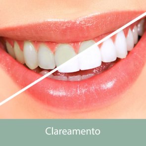 Clareamento